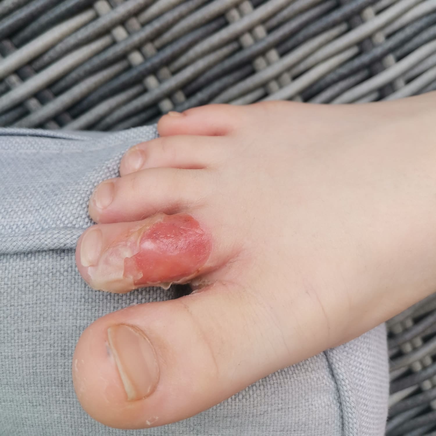 Large blister on foot