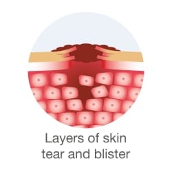 Skin and wound care for EB: Layers of skin graphic