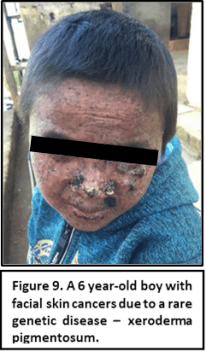 The Burma Skincare Initiative, Managing EB Without Borders