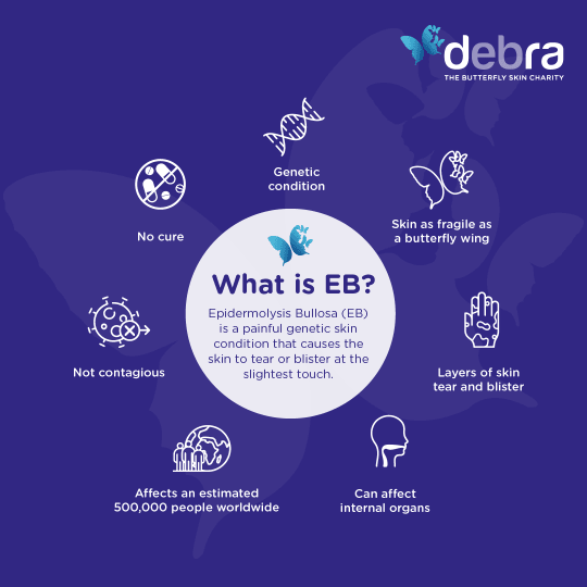 Infographic about what is EB.