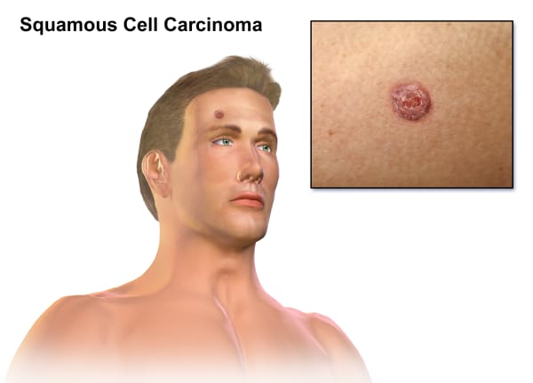 Person with cancerous cell growth on forehead